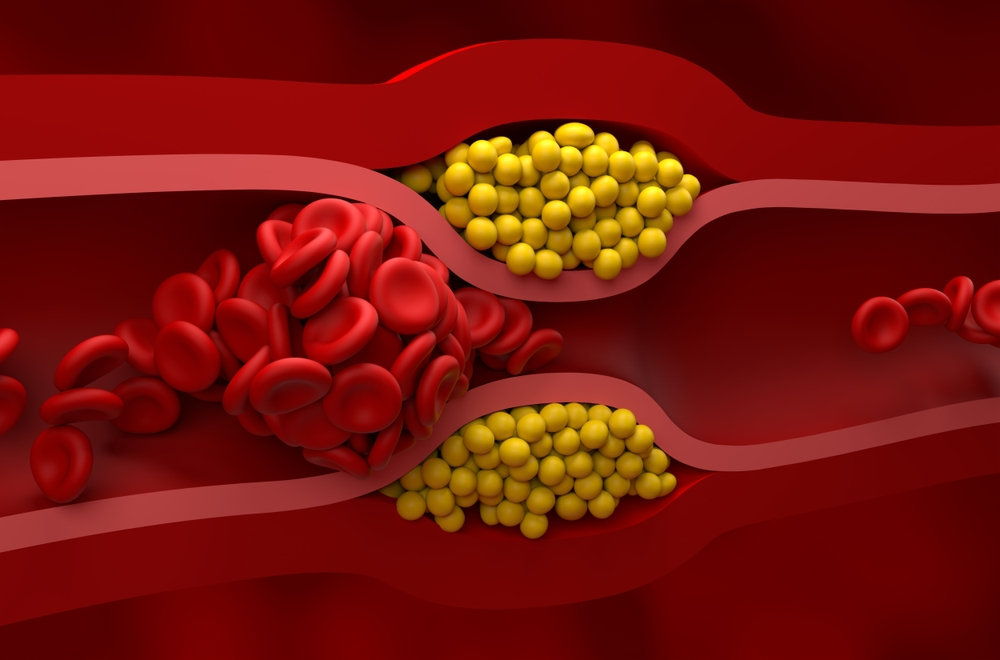 illustration of cholesterol blocking blood vessel